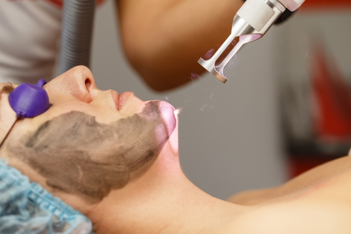 Get Smooth Skin with Carbon Peel in Dubai – Book Now for Flawless Results